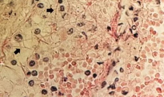 印度病情变异的原因(病毒变异的原因)