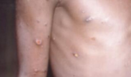 猴痘是什么病毒？猴痘早期症状图片