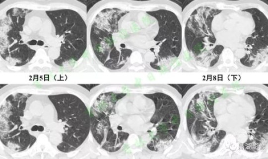 临沂新冠病毒最新情况(冠状病毒肺炎)