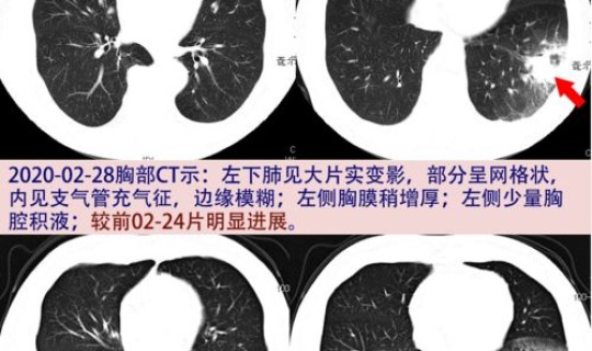 大连发现肺炎，上海肺炎