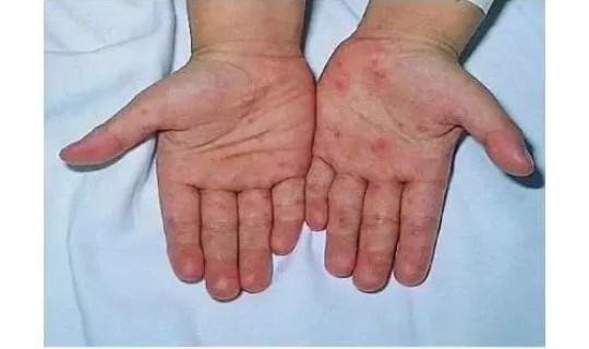 东莞疫情传染源路线 最近广东流行的传染病