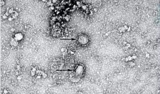 江苏连云港冠状病毒肺炎最新消息？冠状病毒的症状