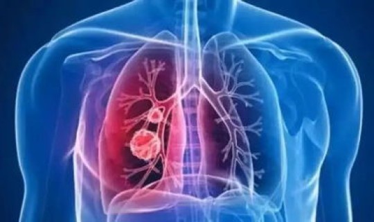 广西肺炎情况分析 有过敏性肺炎吗