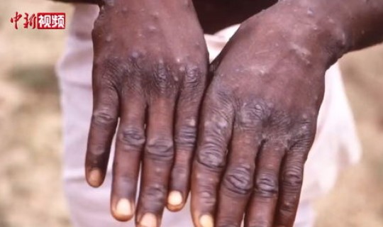 乌鲁木齐新增一例?乌鲁木齐有猴痘病例吗 乌鲁木齐新增一例?乌鲁木齐有猴痘病例吗