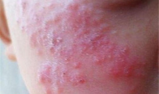 新冠病毒感染小孩能治愈吗？儿童感染新冠病毒会自愈吗