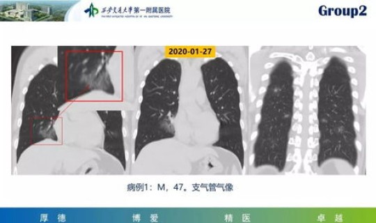 中山新冠肺炎最新情况 冠状病毒肺炎 中山新冠肺炎最新情况 冠状病毒肺炎
