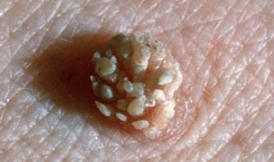 hpv感染一个月可以检测出来嘛 感染了hpv可以同房吗