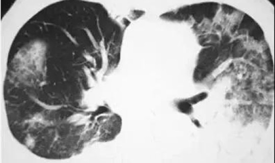 武汉不明肺炎前期症状 武汉不明肺炎最新消息