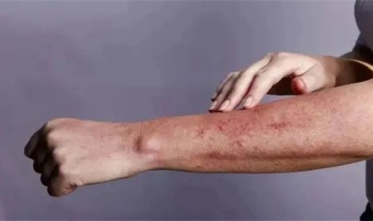 三亚被感染的人数(三亚艾滋病多吗)