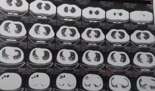 15天了核酸还是阳性？核酸检测一道杠是阴是阳