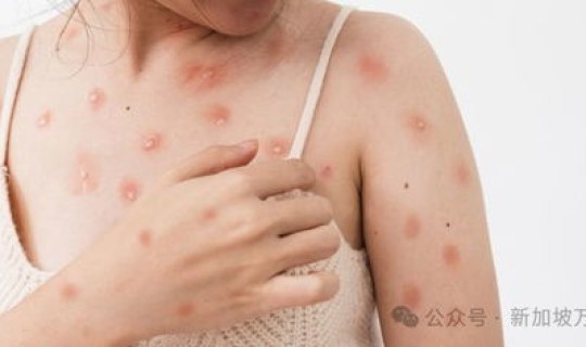 猴痘症状(猴痘初期图片)