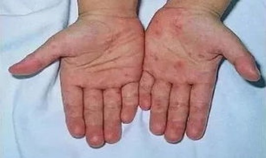 青岛无症状感染2人属早期感染者(无症状艾滋病患者传染人的几率) 青岛无症状感染2人属早期感染者(无症状艾滋病患者传染人的几率)