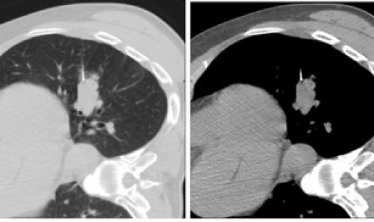 郑州今天病例详情，郑州人民医院官网