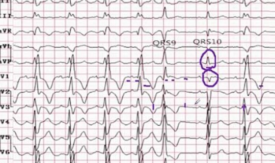 隐匿性传导的基本特征有哪些？隐匿传导名词解释