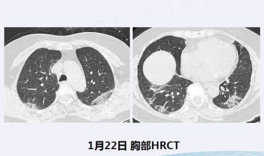 河北新型冠状肺炎最新 新型肺炎实时状态