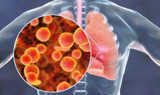 苏州新增肺炎 肺炎的自我判断