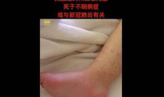 得了新冠的小孩，新冠症状