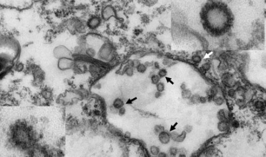 广东排查发现185人感染，广东艾滋病毒感染情况