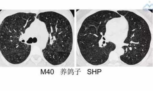 满洲里新冠肺炎情况 新冠肺炎1-7天表现症状