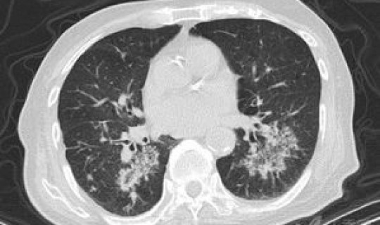 山东新增2例新型肺炎？今天山东又出一例新型肺炎吗