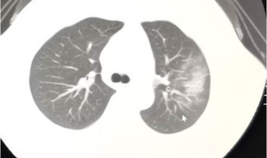 新型冠状病毒无症状感染会传染吗？冠状病毒怎么治疗