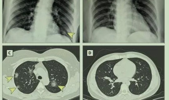 广州多少人感染冠状病毒了，广州最近流行传染疾病