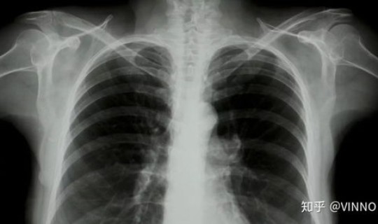 新冠肺炎年底还会爆发吗 新冠肺炎会再次爆发吗