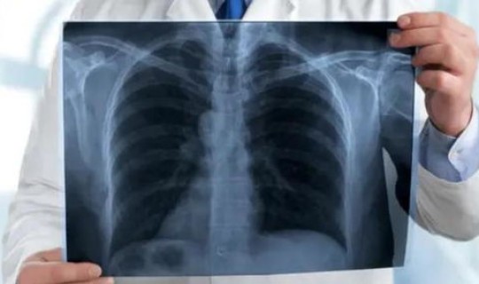 广东哪里的疫情比较严重 广东新型肺炎疫情