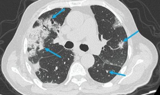 海珠区感染肺炎(肺炎支原体感染)