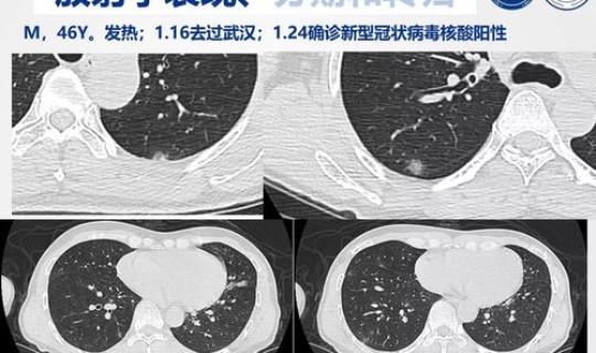 海南最新冠状肺炎消息今天(新冠状肺炎的早期症状)