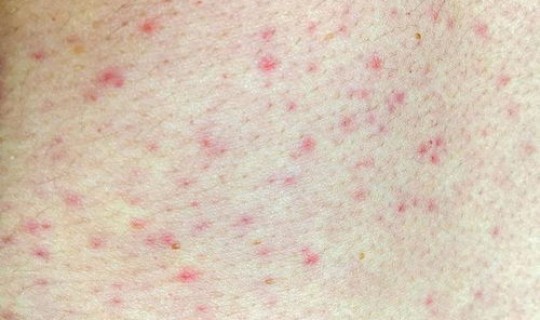 黑龙江最新感染情况 黑龙江多少艾滋病患者