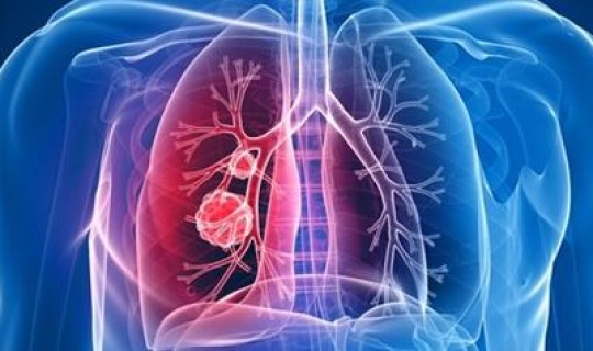 美国肺炎死亡率高吗 脑梗引起肺炎死亡率高吗