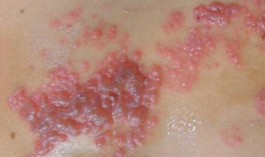 无症状到底会不会传染给别人，疱疹病毒会传染别人吗