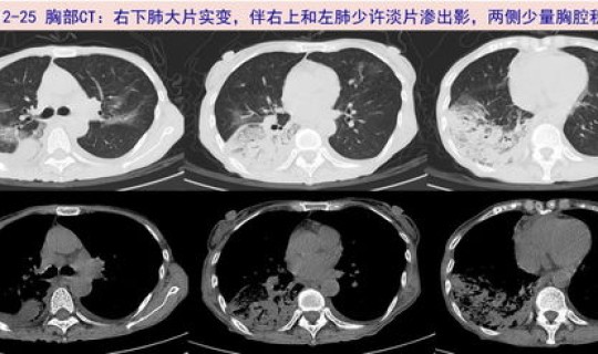 苏州新增的新型肺炎是哪里的？苏州3例新型肺炎在哪里