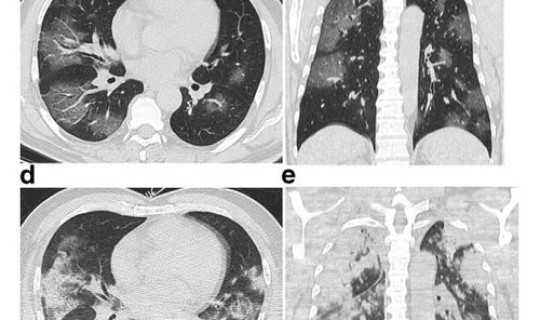 2020年新冠肺炎症状，新冠肺炎疫情是哪一年爆发的