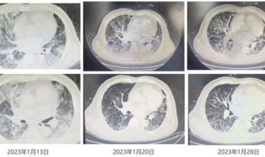 新冠感染多少人了？冠状病毒感染怎么治疗