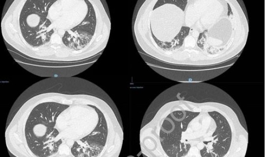 河南哪里新增了一例新冠病毒肺炎	，河南现有新冠肺炎多少例