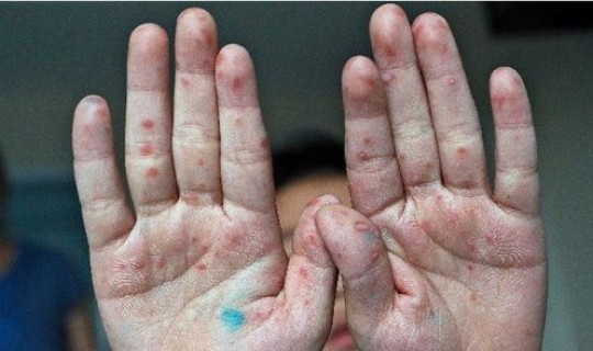 陕西最新病情，西安最近的传染病毒