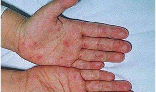 黑龙江有役情吗，黑龙江多少艾滋病患者