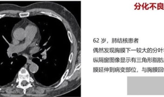 隐匿性病灶?隐匿性肺癌 隐匿性病灶?隐匿性肺癌