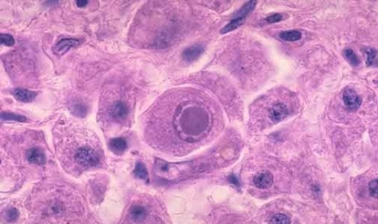 隐匿性病毒感染?隐球菌感染是艾滋病吗 隐匿性病毒感染?隐球菌感染是艾滋病吗