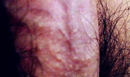 感染新冠多长时间有传染性？感染艾滋病毒多久会有症状