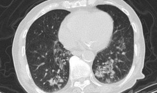陕西3例新型肺炎 陕西昨天一例是那里的