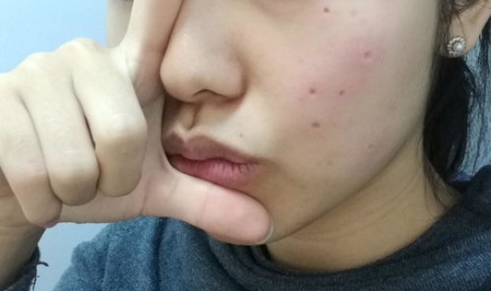 烟台点痣去哪个医院？点痣有必要去大医院吗