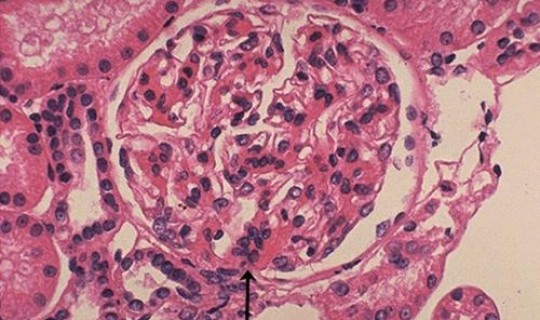 无症状感染率高吗，eb病毒感染率高吗