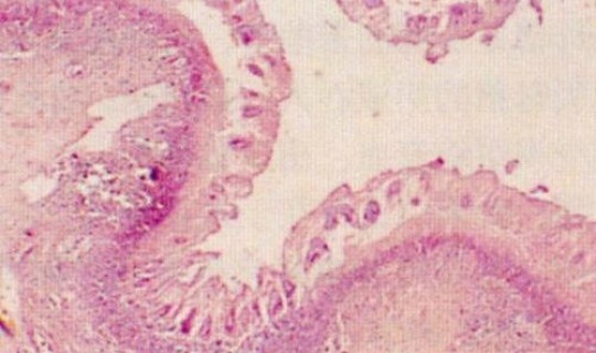 湛江病毒感染事件 病毒感染和细菌感染哪个严重