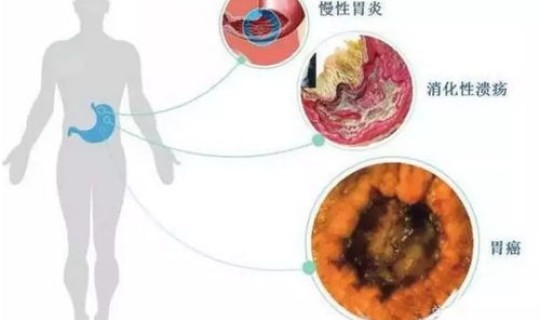 221人感染(人感染布氏杆菌病症状)