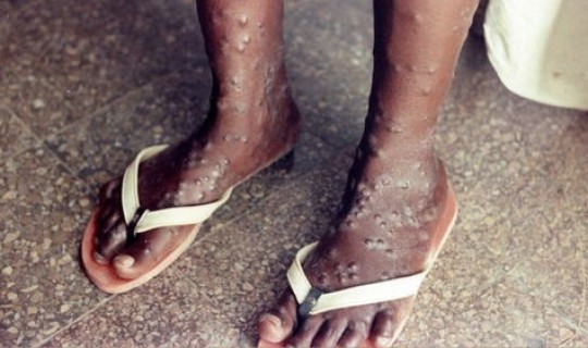 美国猴痘病毒感染，猴痘病毒的临床症状