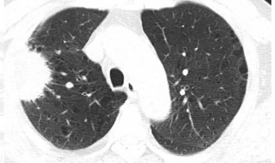 黑河有几例新型肺炎患者？黑龙江有几例肺炎最新