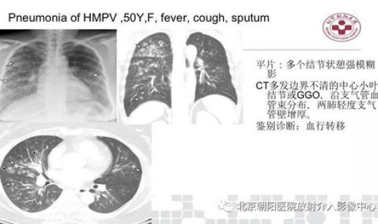 河北病毒性肺炎最新情况(病毒性肺炎能自愈吗) 河北病毒性肺炎最新情况(病毒性肺炎能自愈吗)